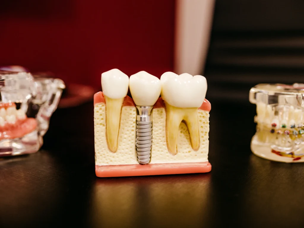 model of a single tooth dental implant | cost of dental implants in Worcester, MA